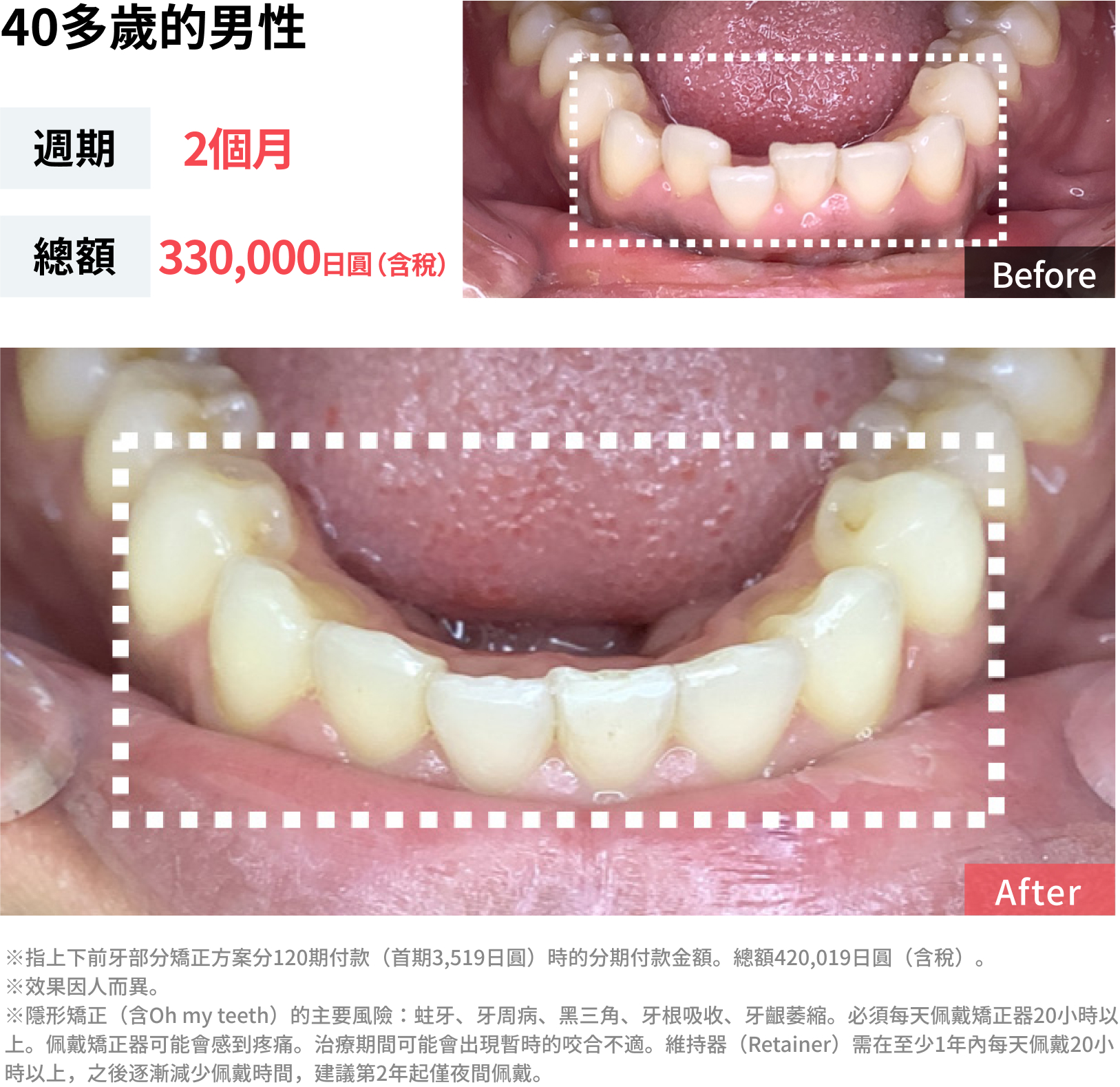 牙齒歪斜的案例照片