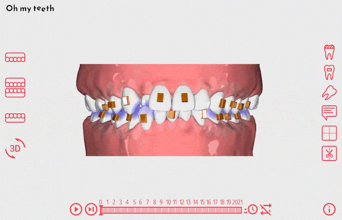 矯正シミュレーション