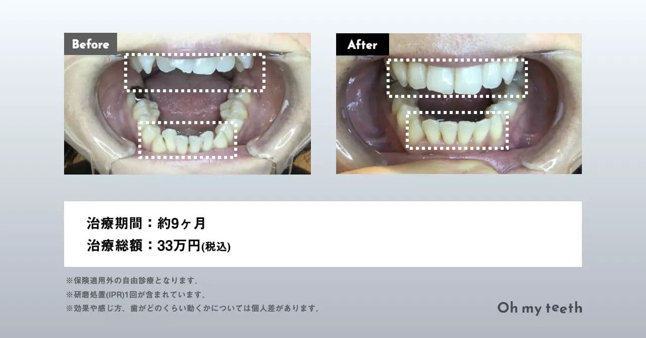 マウスピース矯正 Oh my teeth の八重歯の症例(部分矯正)