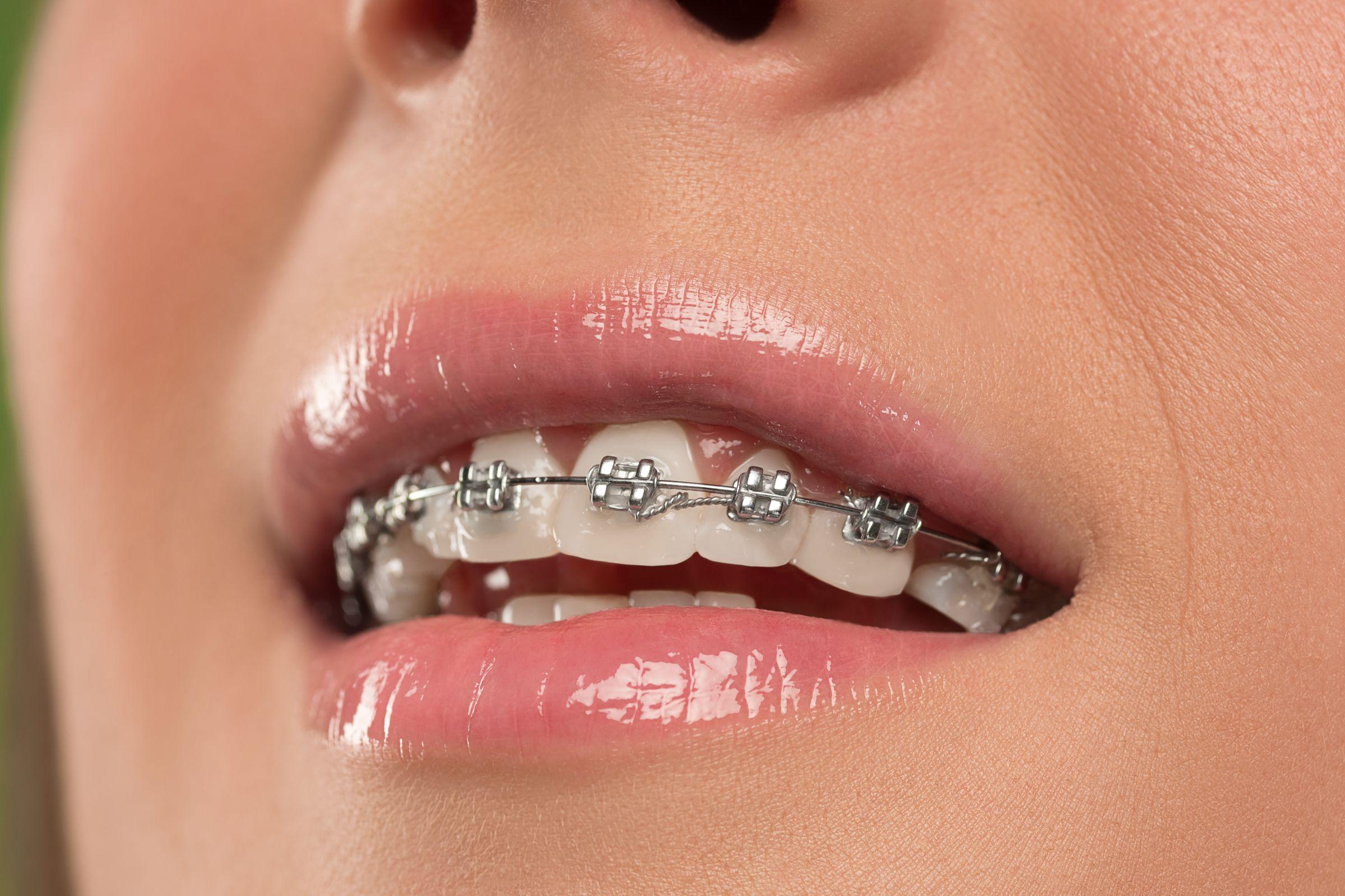 歯科矯正を安くする方法8つ！後悔しないためにできること