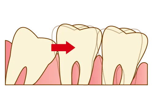 親知らずが前の歯を押しているイメージ