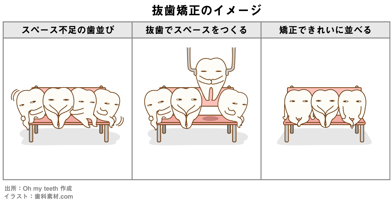 抜歯矯正のイメージ