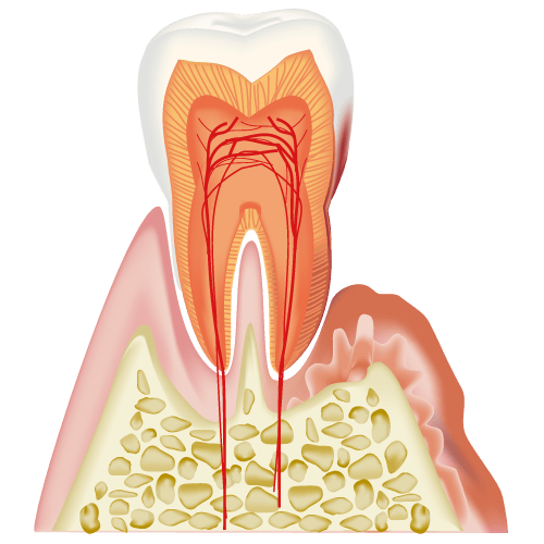 歯周病でも矯正できる？矯正中の歯周病予防法3つ