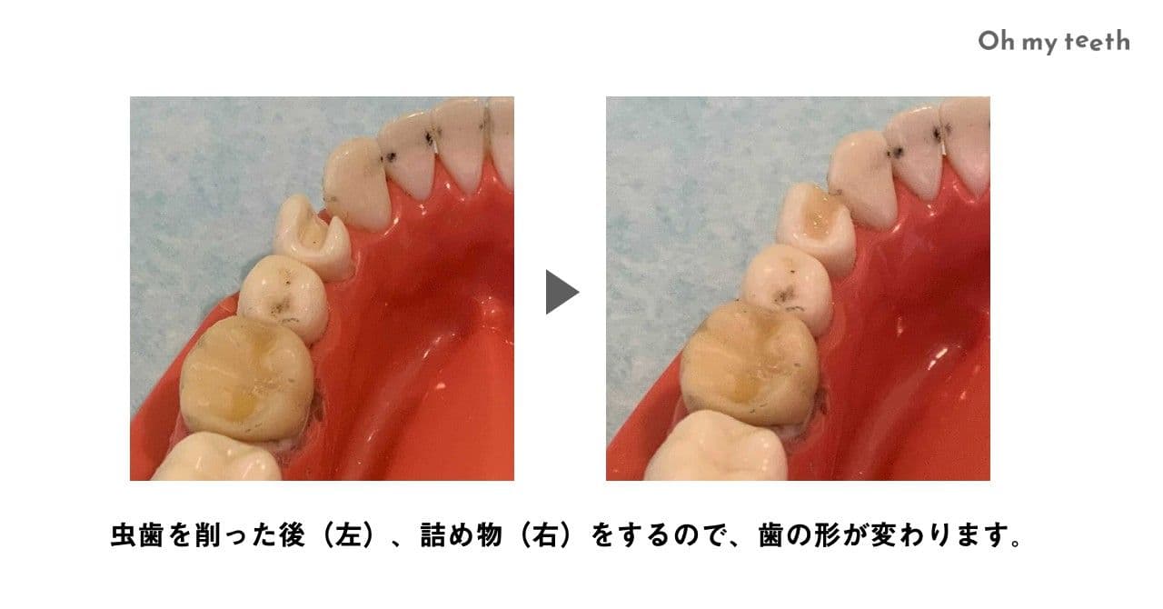 顎模型上で虫歯の治療をした画像