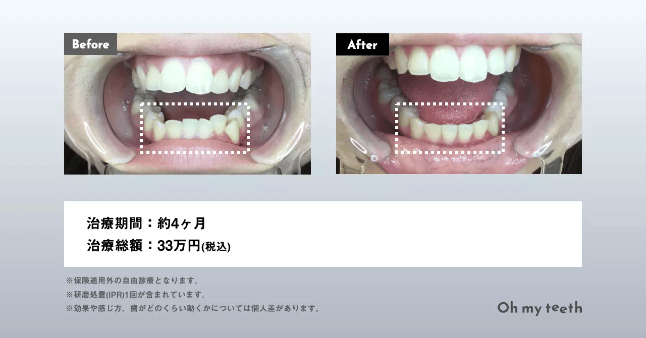 マウスピース矯正 Oh my teethの八重歯の症例(部分矯正)