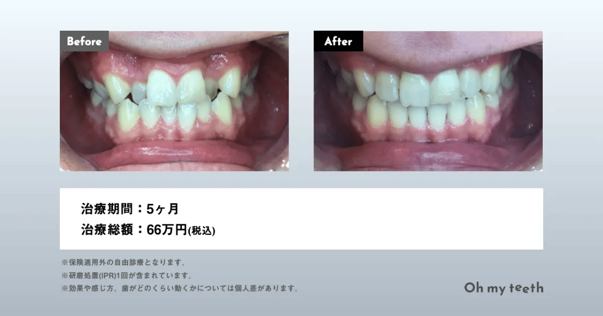 歯が小さいのを大きくできる？原因や治し方を解説