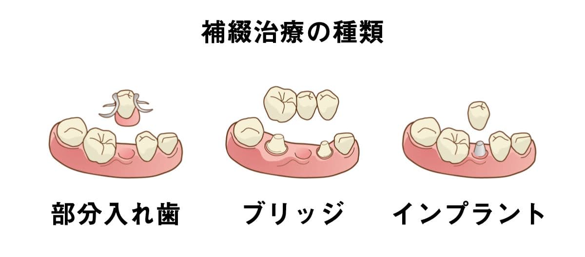 補綴治療の種類