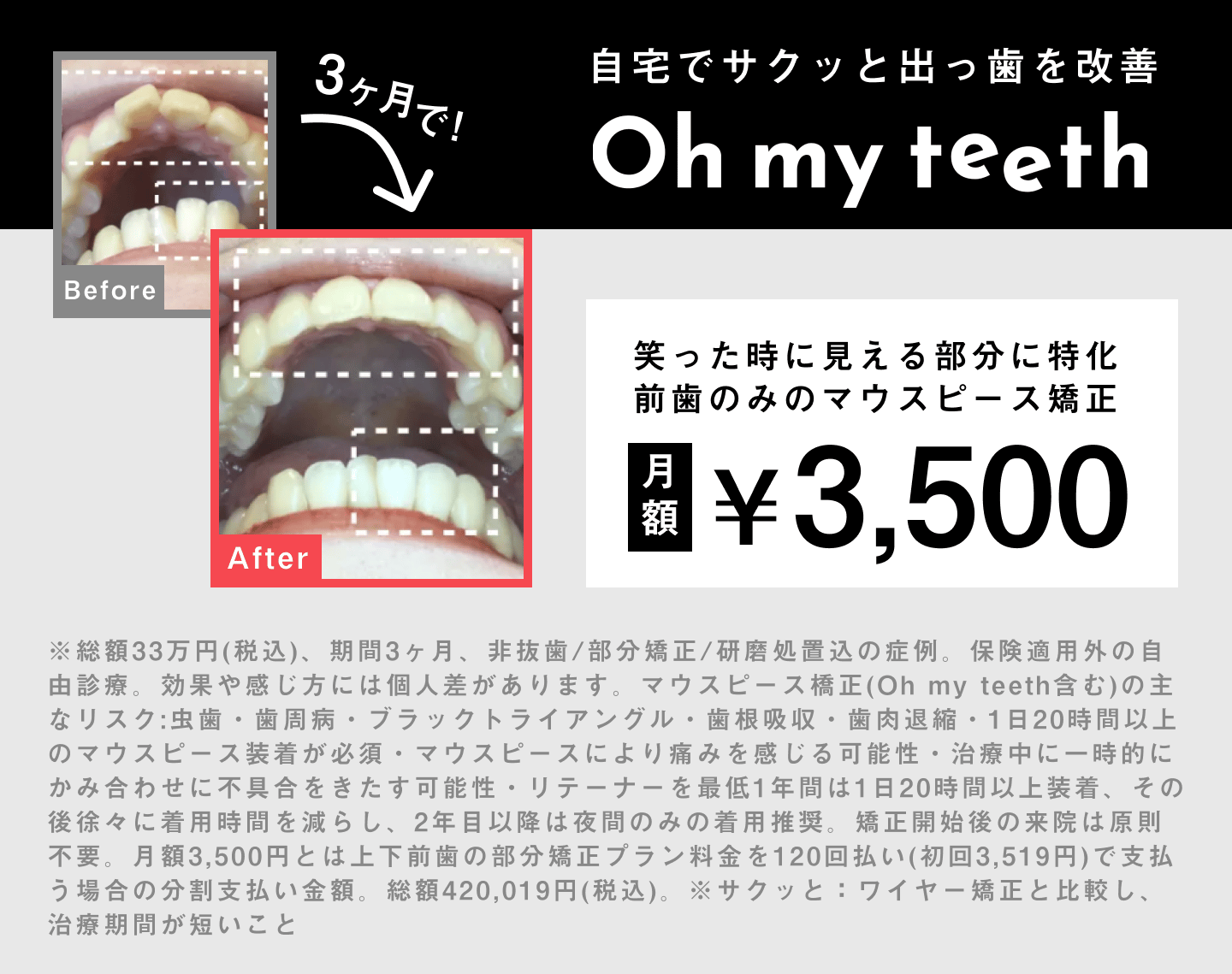 出っ歯改善症例カバー