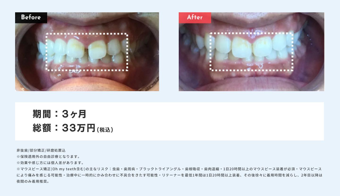 マウスピース矯正 Oh my teethのすきっ歯(空隙歯列)の症例