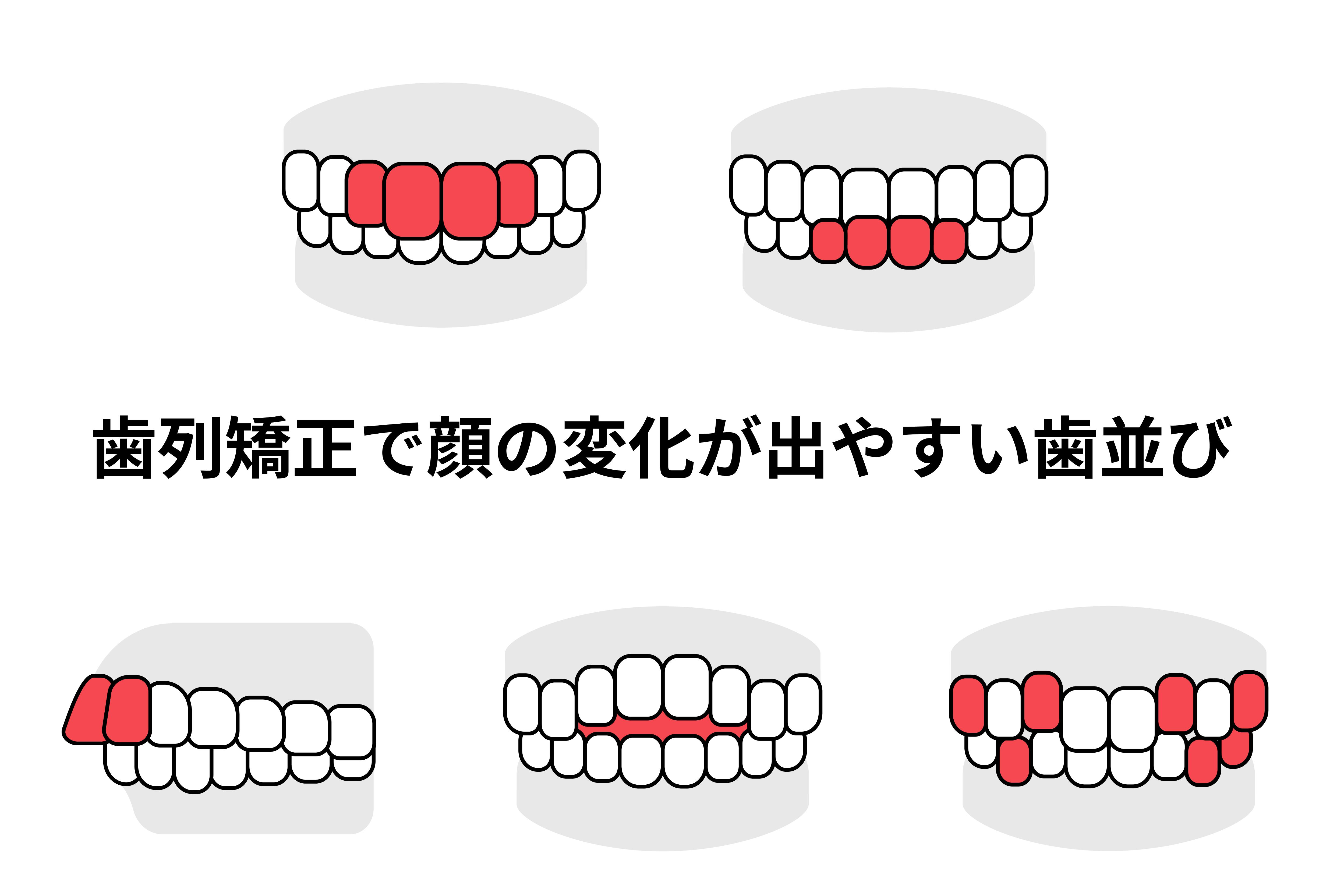 歯列矯正で顔は変わる?期待できる5つの変化と注意点を解説