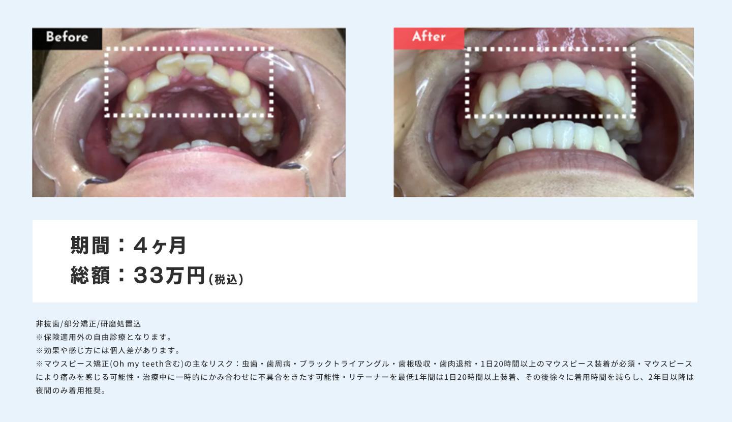 マウスピース矯正 Oh my teethの出っ歯の症例