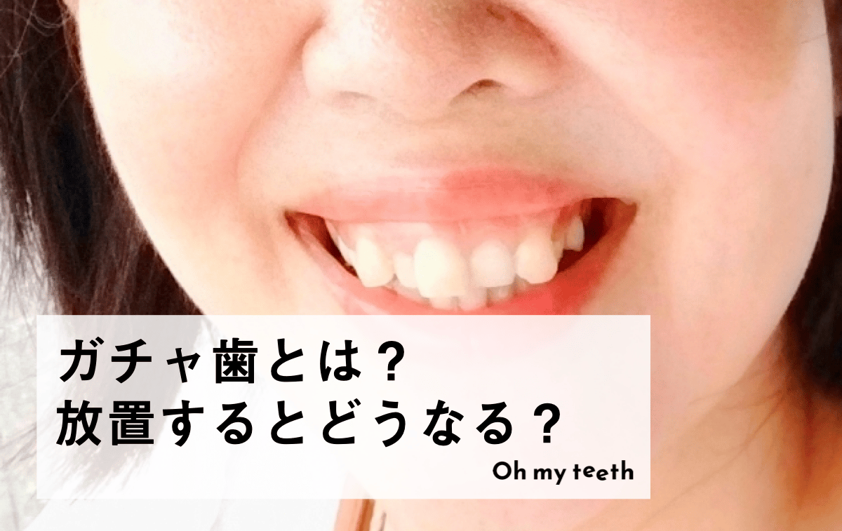 ガチャ歯を放置するリスクとは？