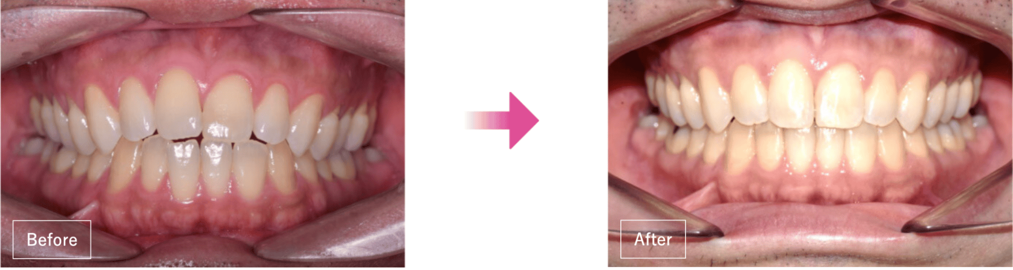 クリアライン矯正の前歯のガタつき(叢生)の症例(5回実施)