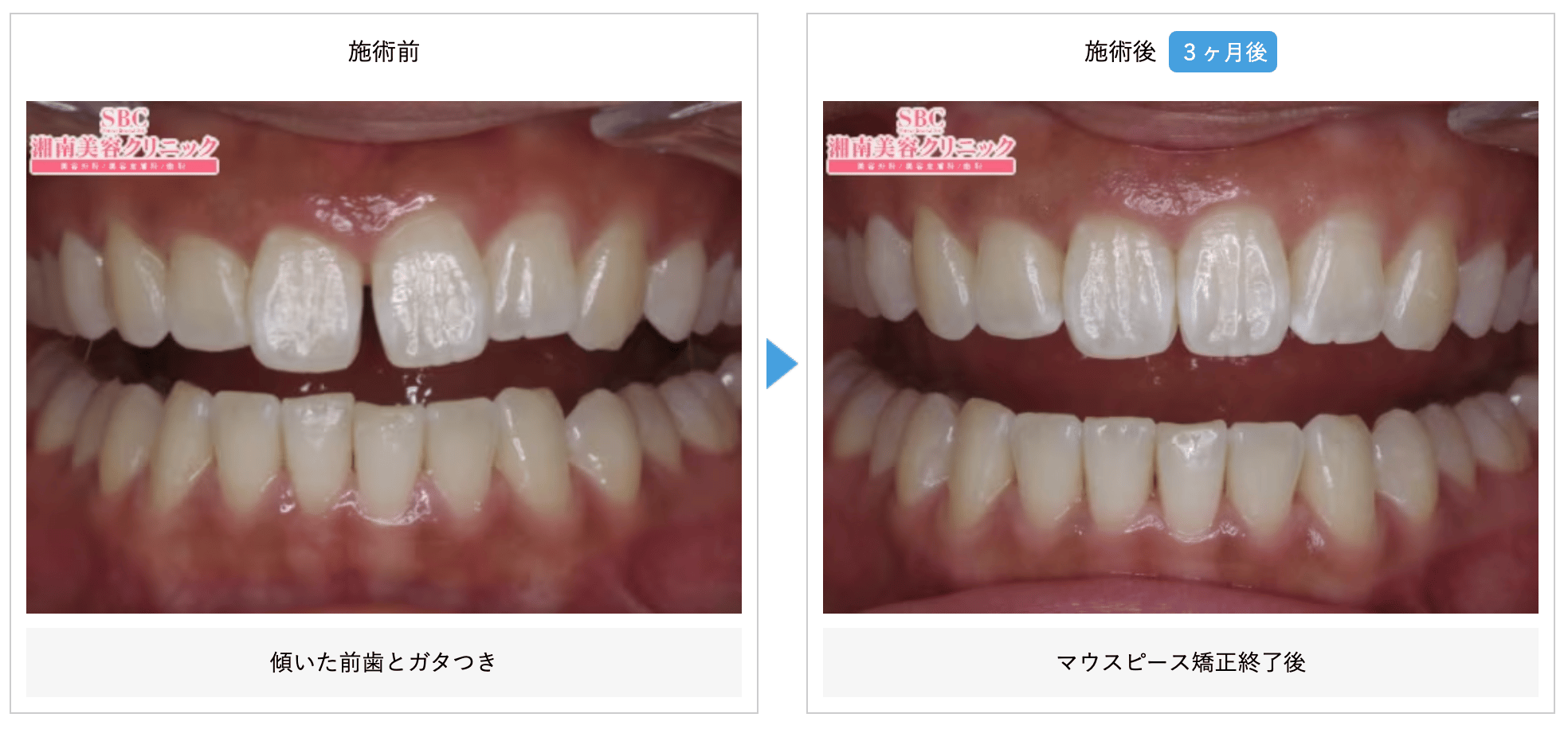 湘南美容歯科のマウスピース矯正の症例①