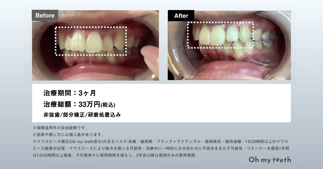 Oh my teeth 症例 (出っ歯・女性・20代)