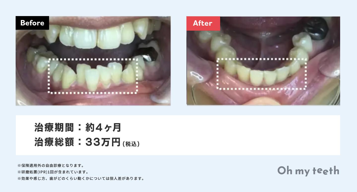 マウスピース矯正 Oh my teethのガタガタ歯の症例