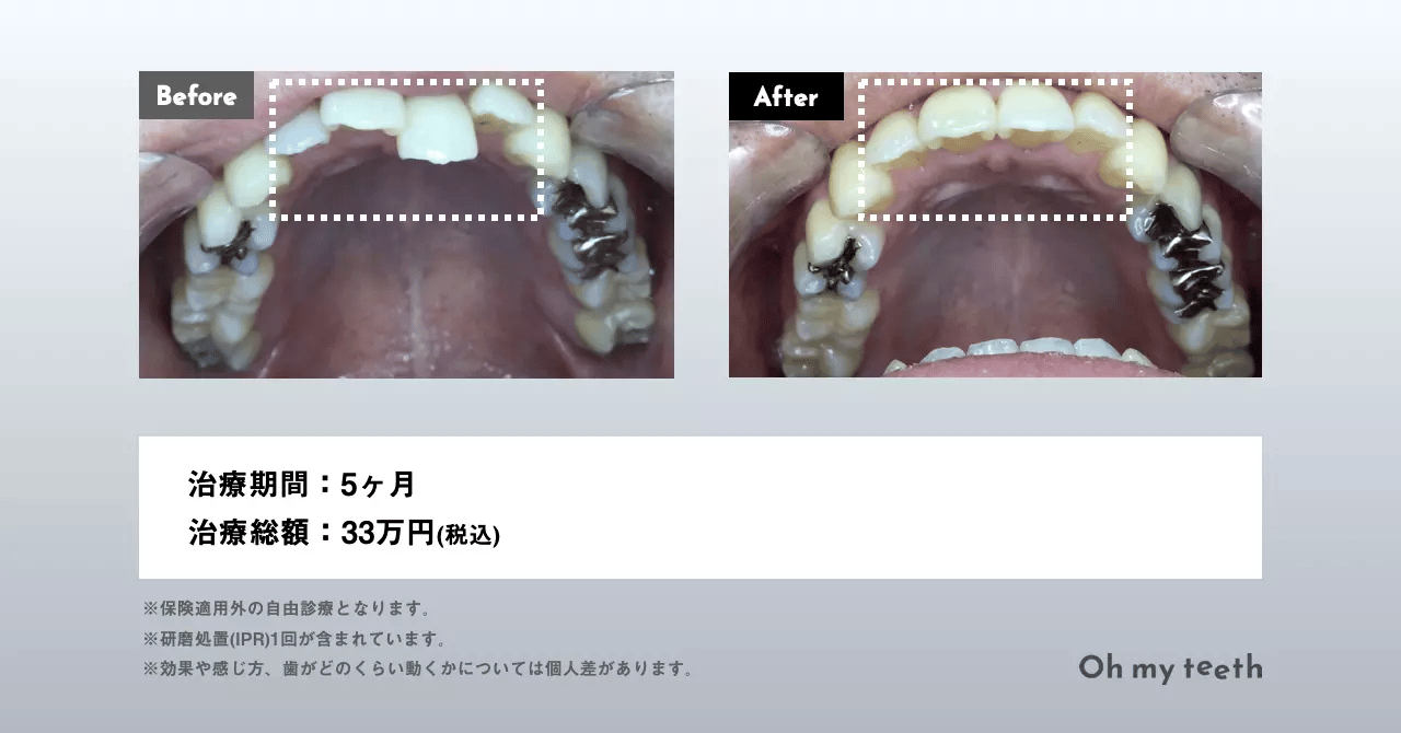 マウスピース矯正 Oh my teethの部分矯正の症例