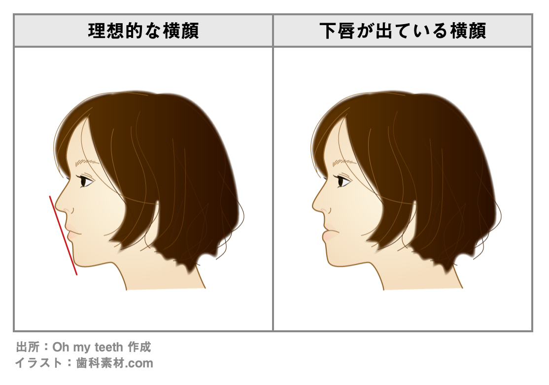 理想的な横顔と下唇が出ている横顔の比較を表したイラスト