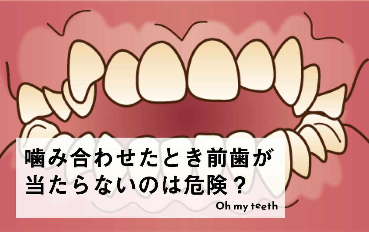 ‎噛み合わせたときに前歯が当たらないのは危険？