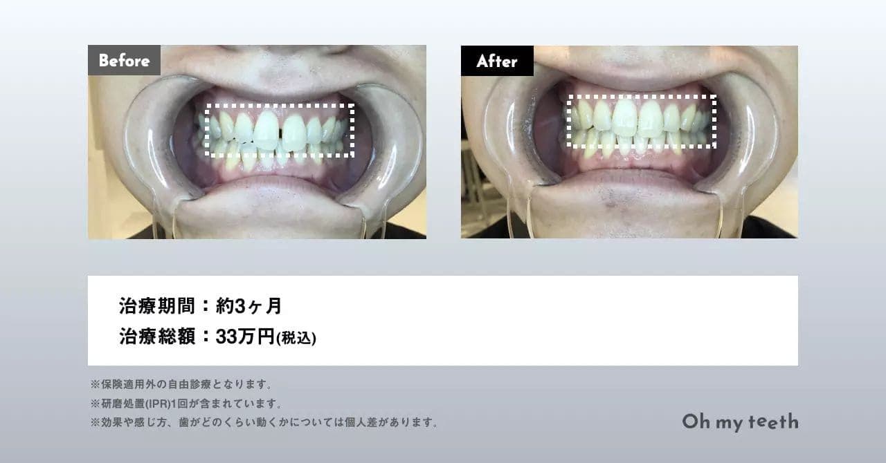 マウスピース矯正 Oh my teethのすきっ歯の症例(空隙歯列)