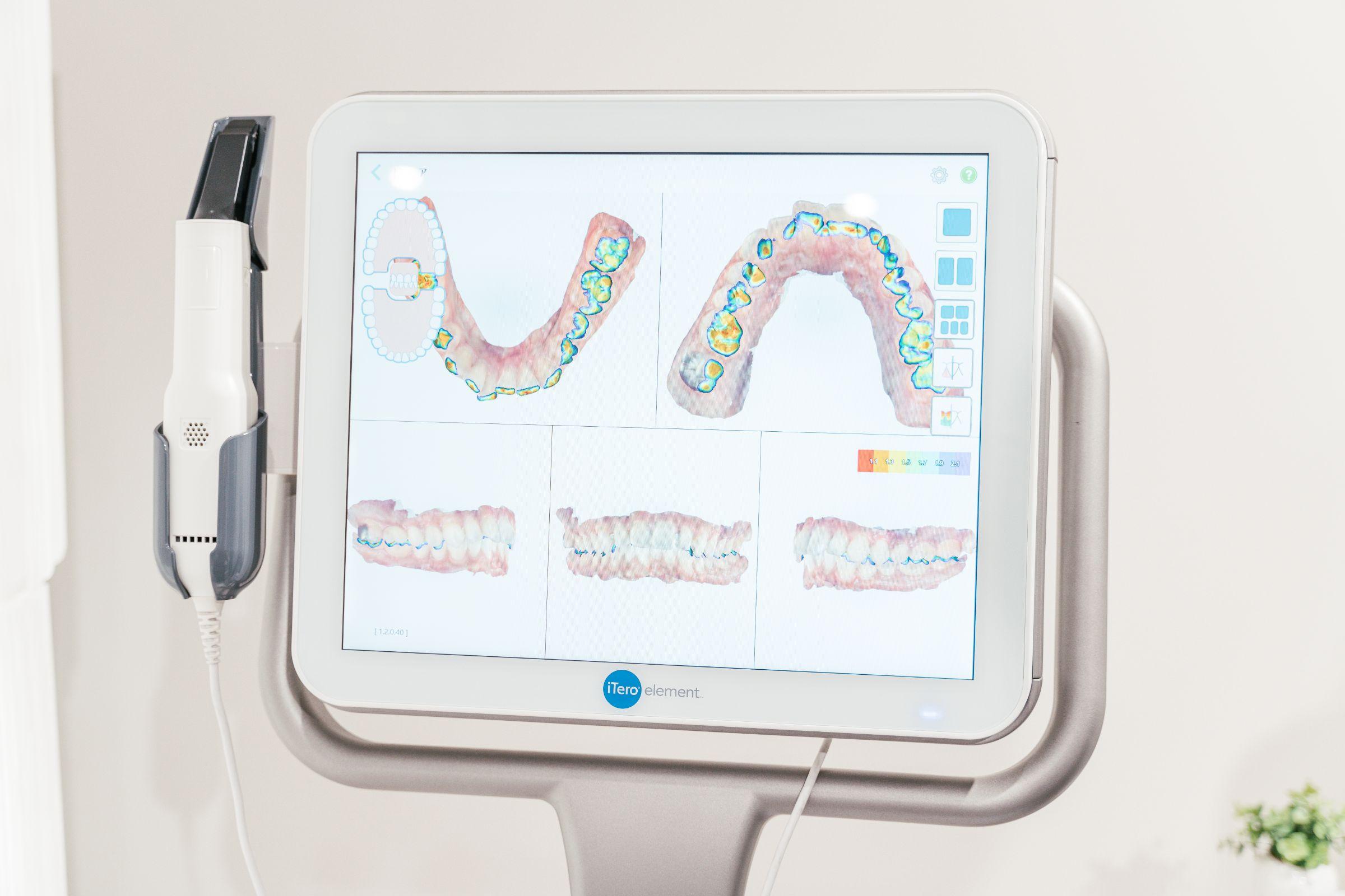 Oh my teethの3D歯型スキャンによって可視化された噛み合わせの状態