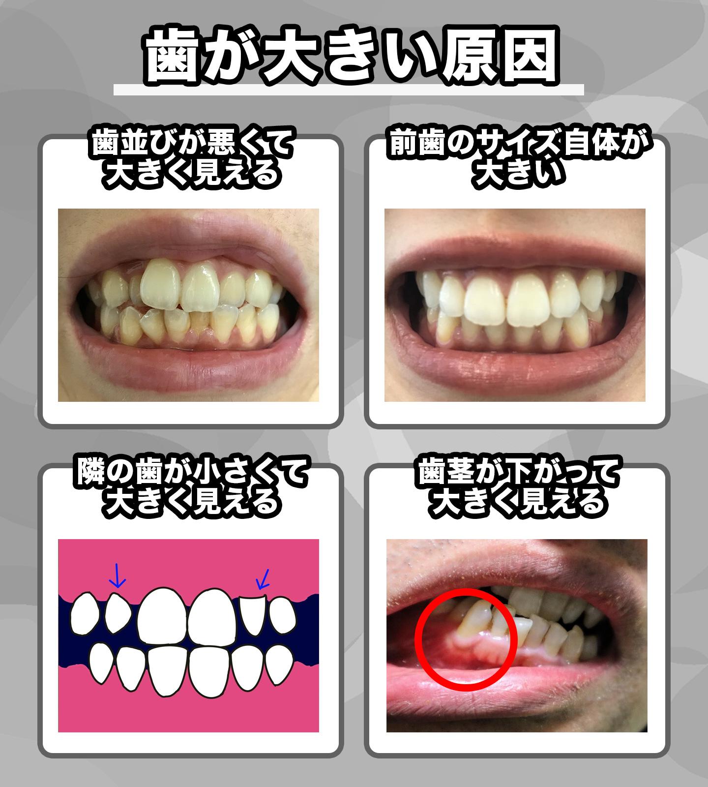 前歯が大きい4つの原因