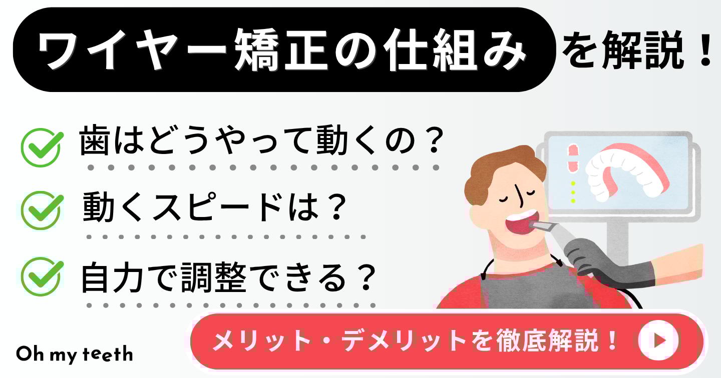 ワイヤー矯正 仕組み アイキャッチ