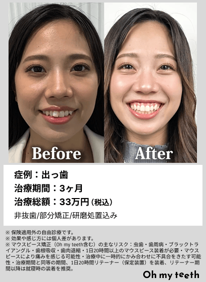 全顔BA・出っ歯