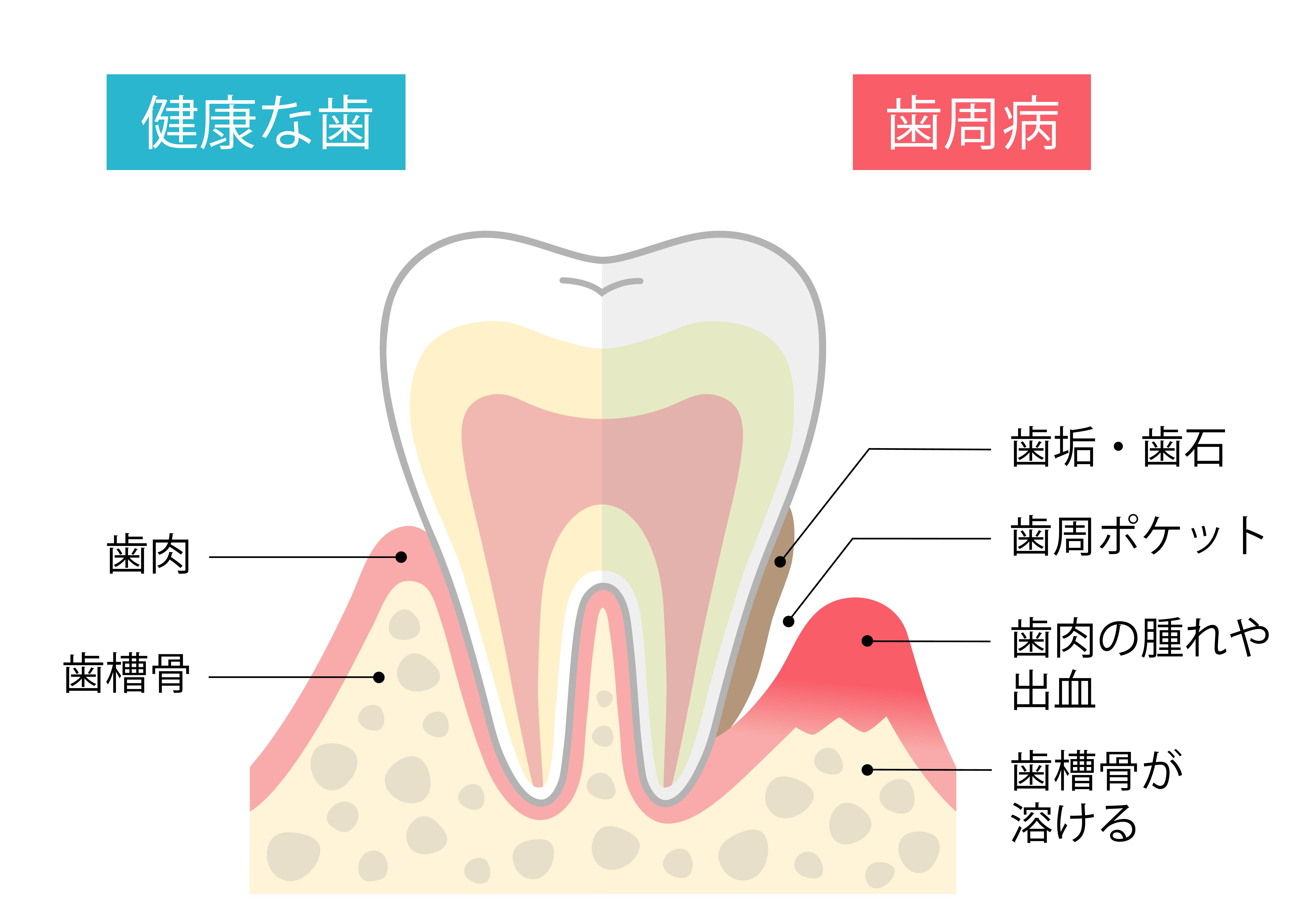 歯周病とは