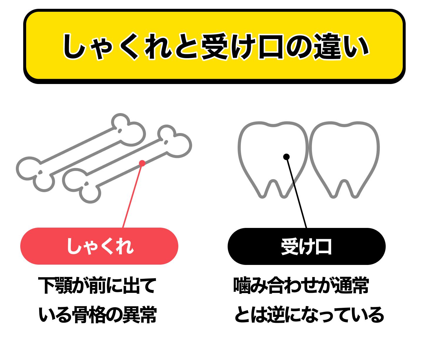 しゃくれと受け口の違い