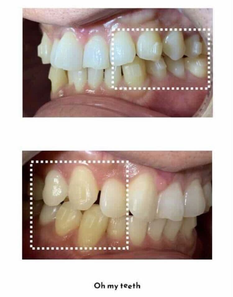 マウスピース矯正 Oh my teethユーザーの歯に固定されたアタッチメント