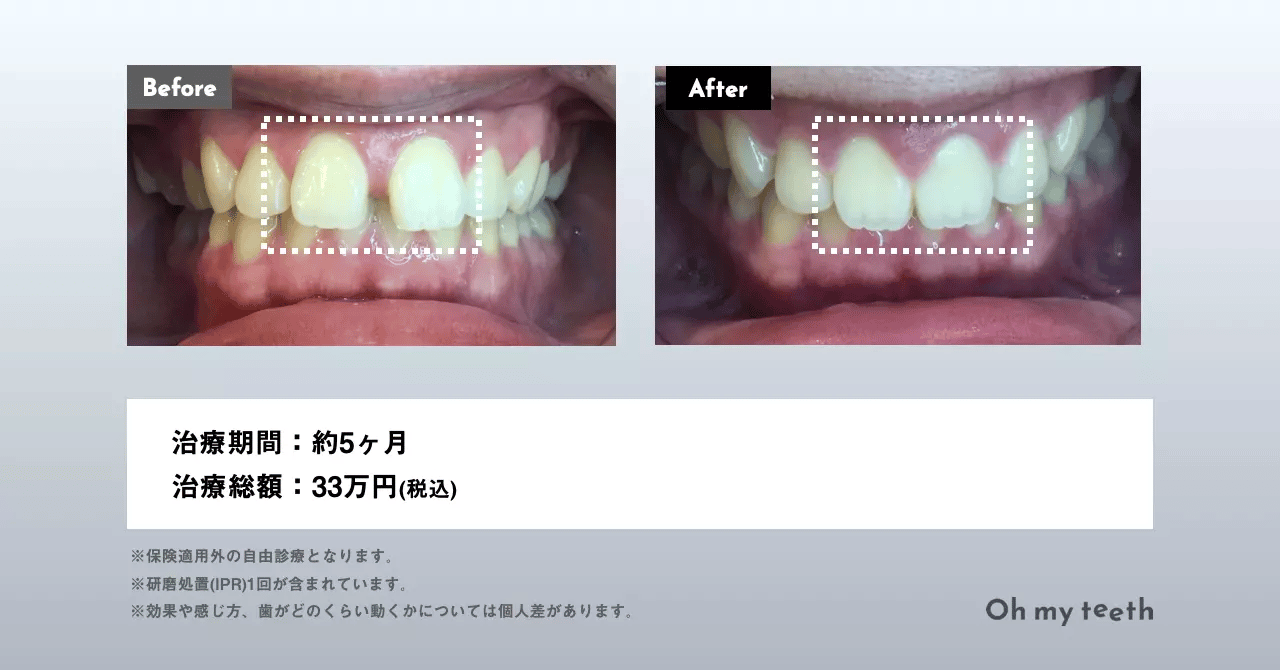 マウスピース矯正 Oh my teethのすきっ歯(空隙歯列)の症例