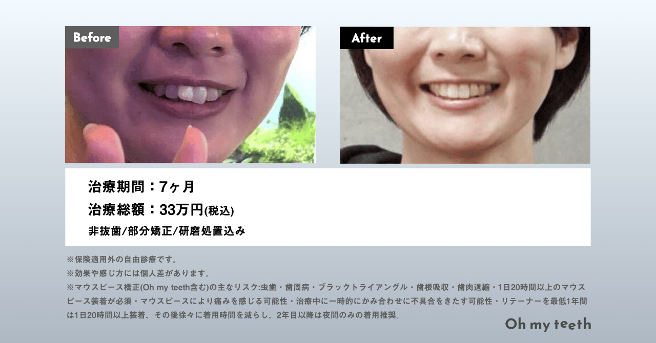 Oh my teethの症例(出っ歯・顔貌変化)