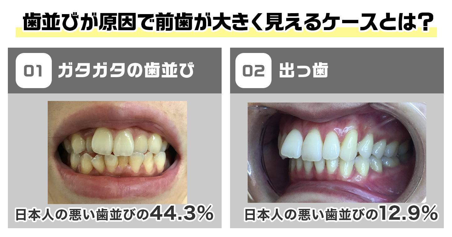 歯並びが原因で前歯が大きく見えるケース
