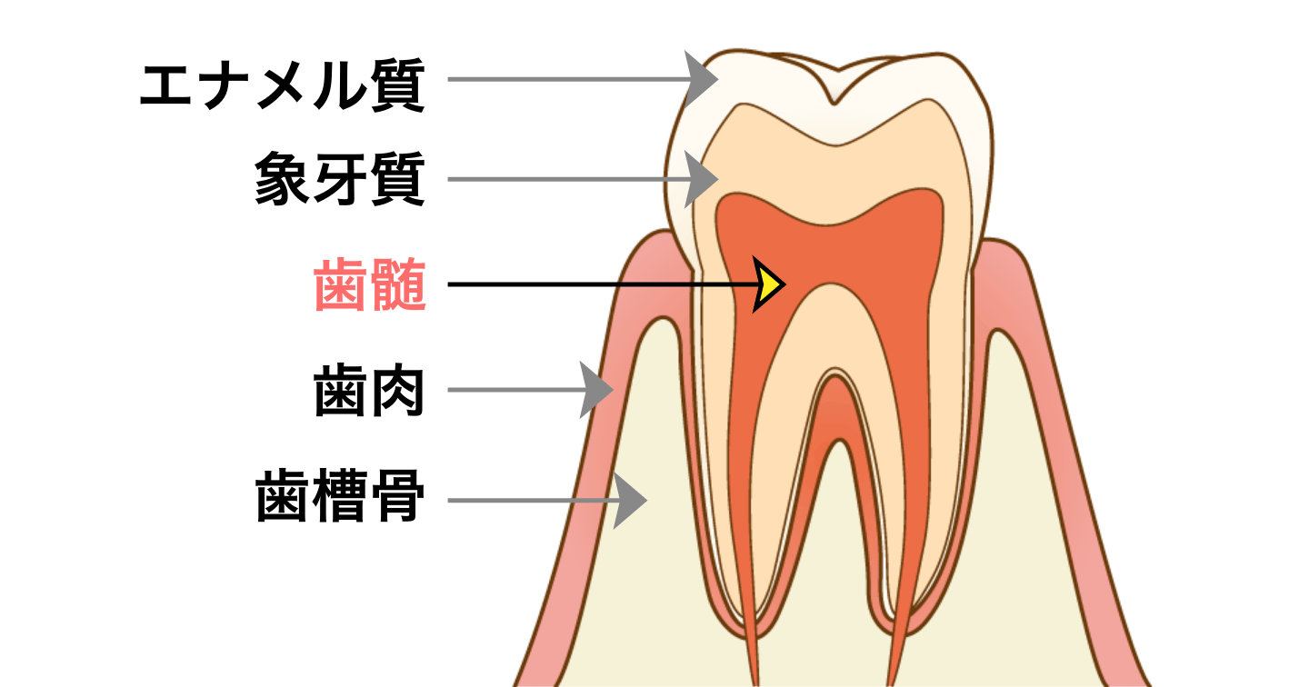 歯髄炎