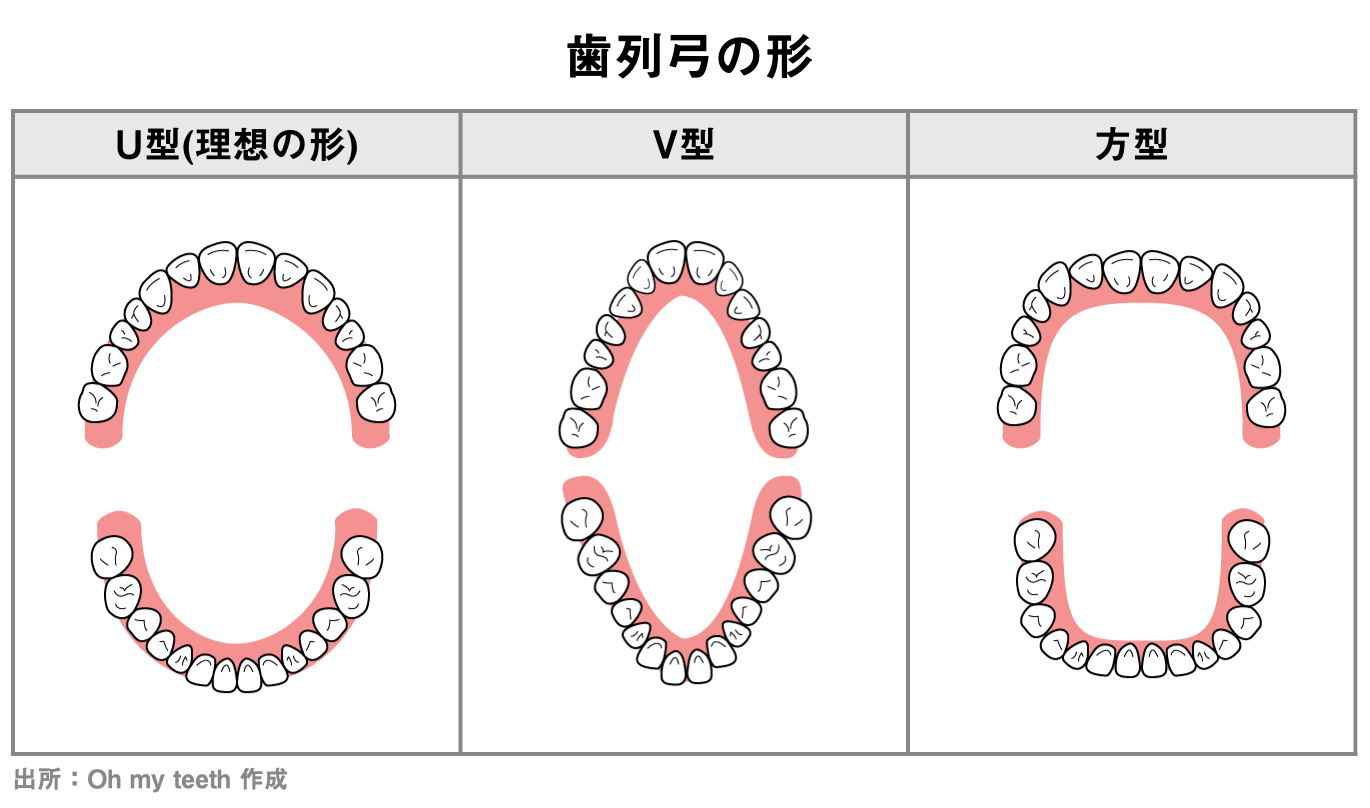 歯のアーチ(歯列弓)の3つのパターン