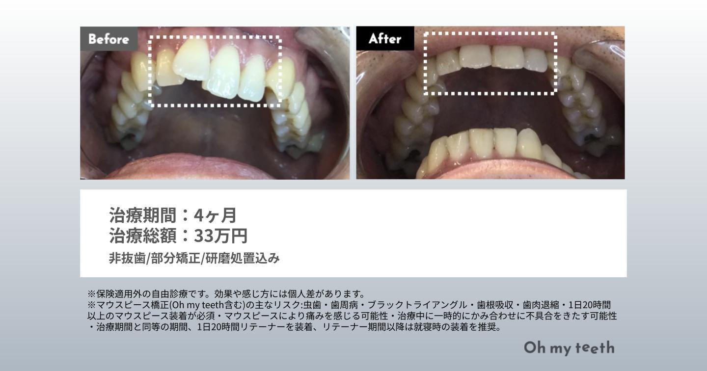 48歳・男性・Basic・4カ月症例（叢生、出っ歯）