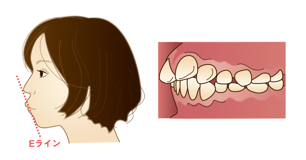 出っ歯の横顔と歯並び