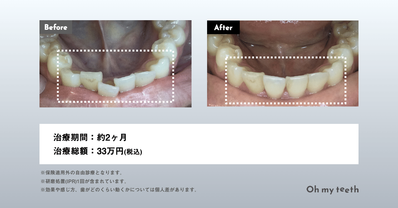 非抜歯矯正は後悔する？よくある誤解と4つの失敗例