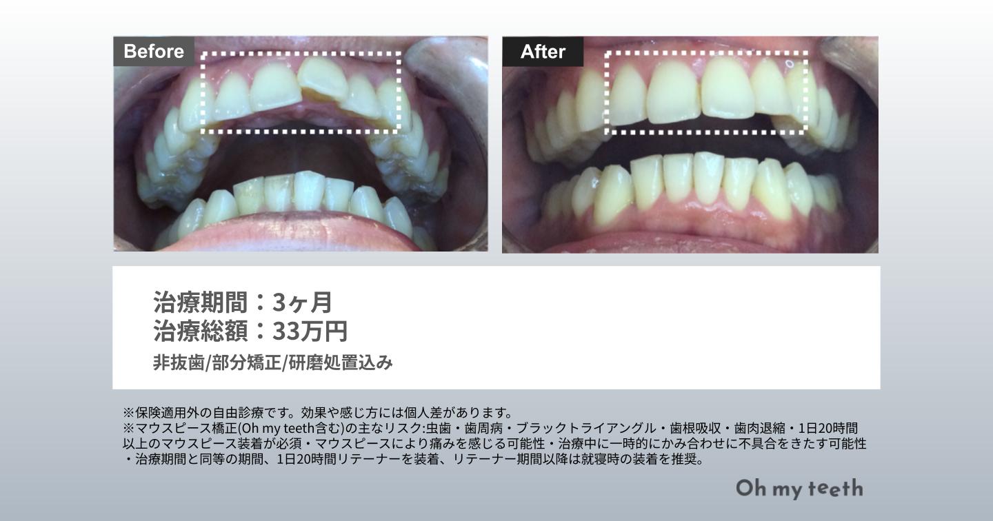 捻転歯 症例写真(1本ねじれ3ヶ月)
