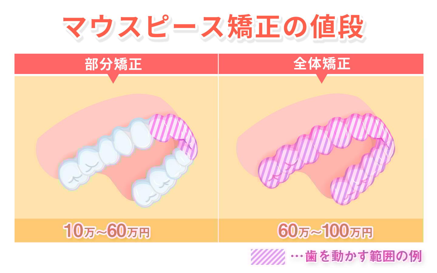 マウスピース矯正