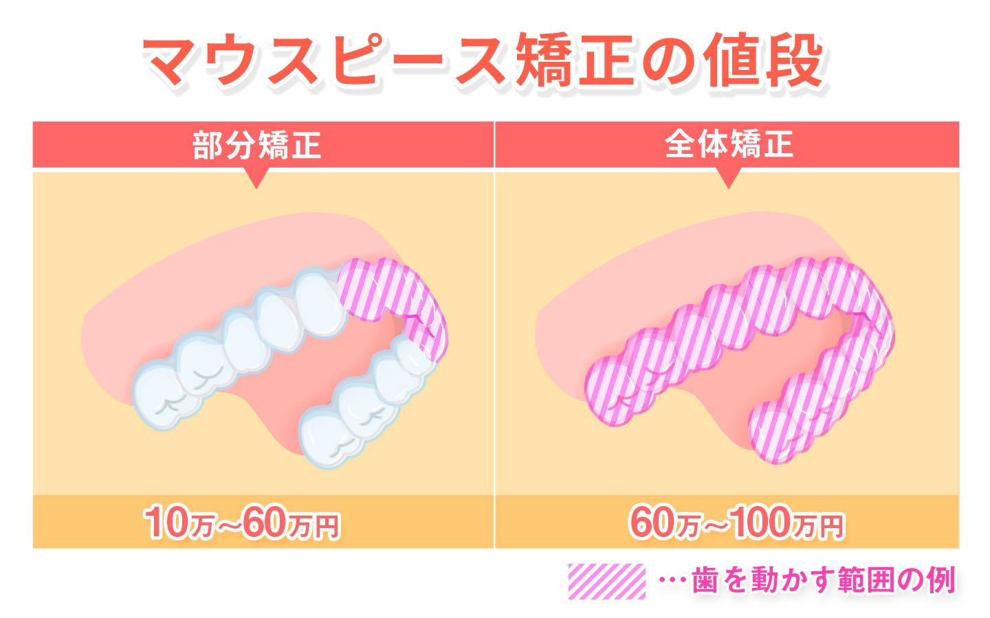 マウスピース矯正