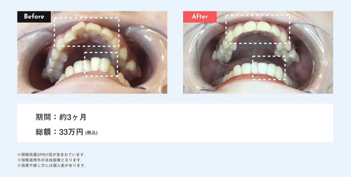 マウスピース矯正 Oh my teethの出っ歯の症例