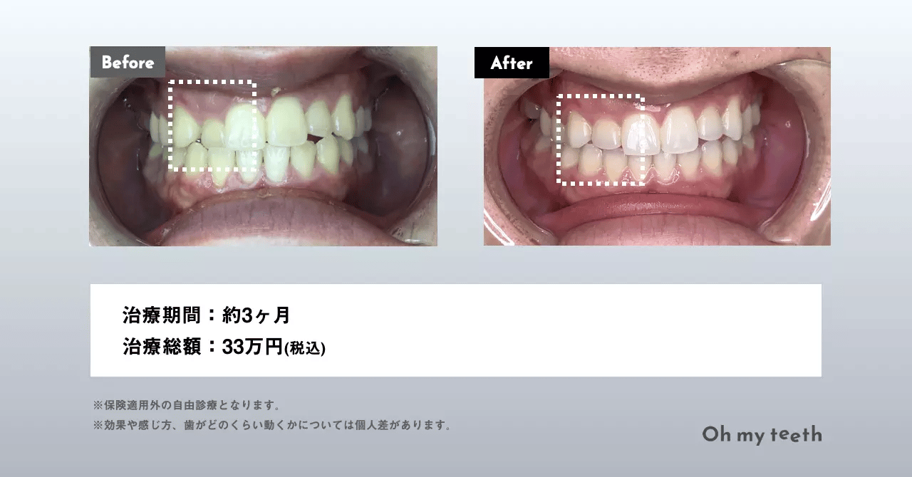 歯が小さいのを大きくできる？原因や治し方を解説