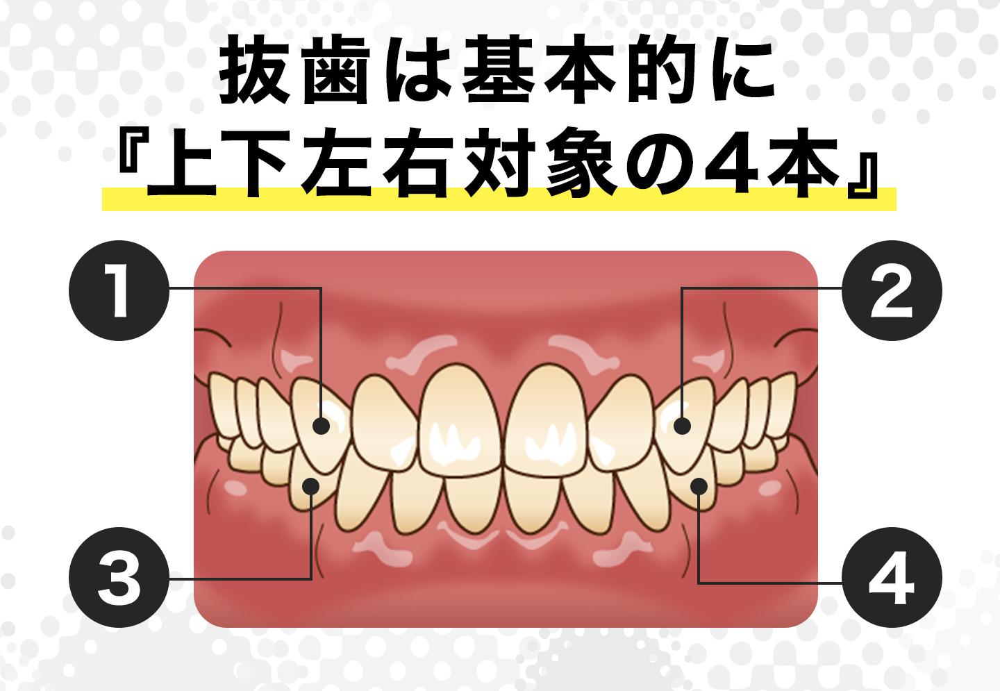 抜歯は左右対称の4本