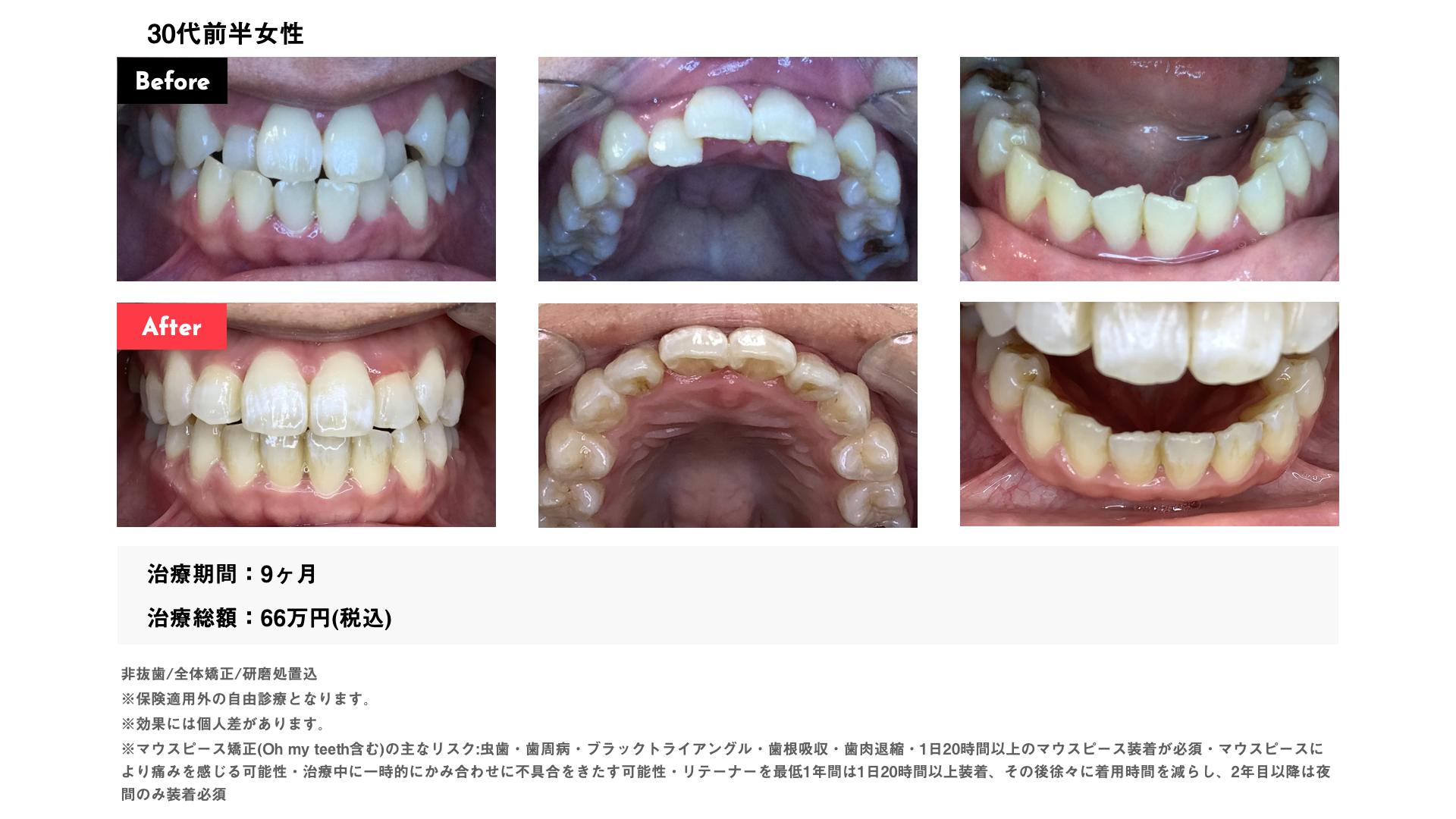受け口　30代前半女性　症例写真