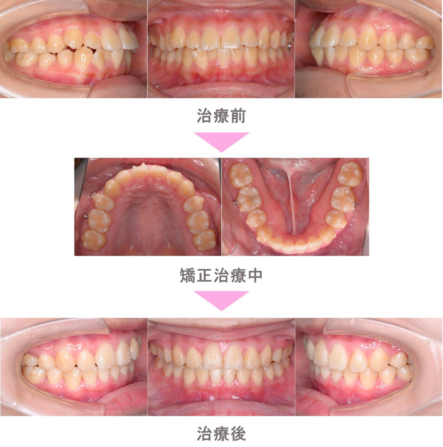 インビザライン矯正(マウスピース矯正)の出っ歯(上顎前突)の症例