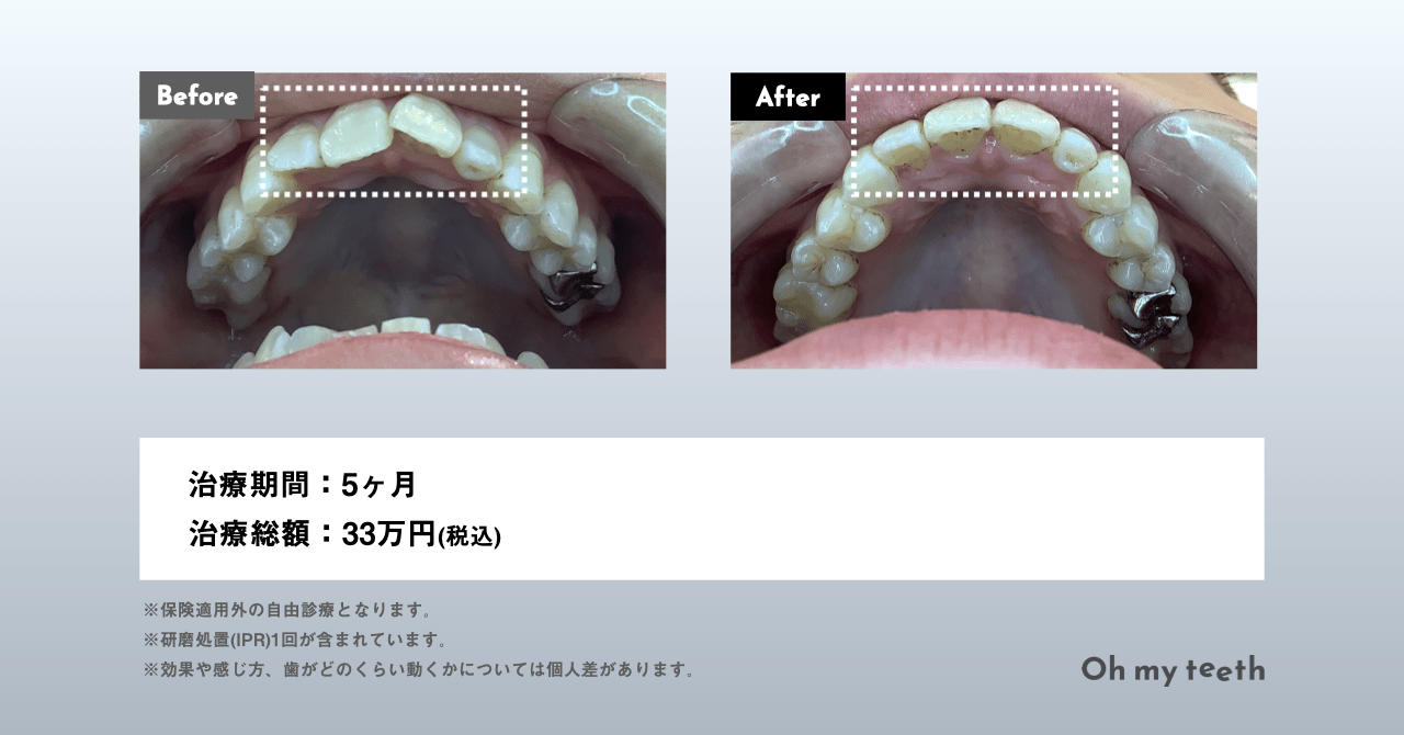 妊娠中に矯正しても大丈夫？レントゲンや抜歯など注意点を解説