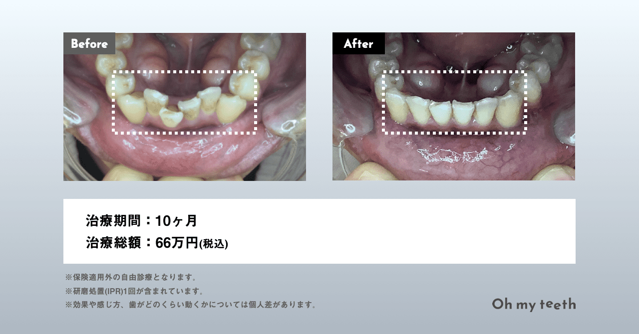 マウスピース矯正 Oh my teethの症例(下の歯・全体矯正・叢生)