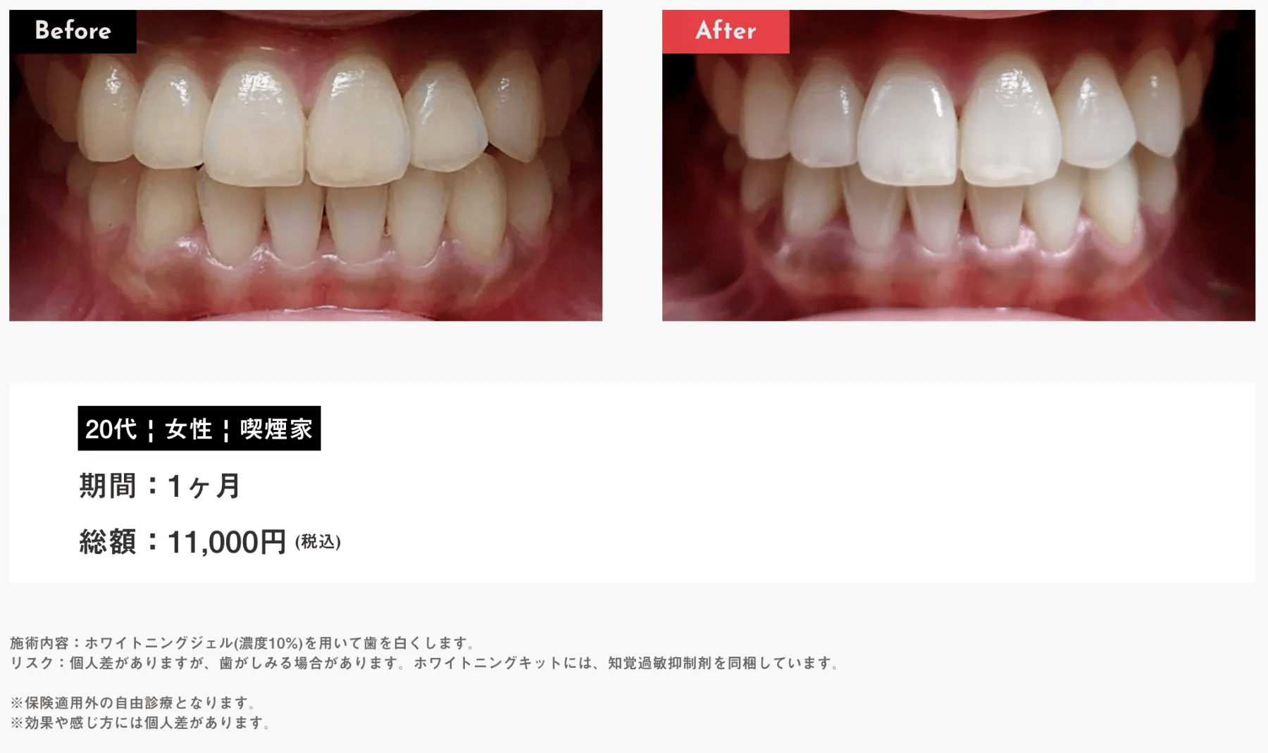 Oh my teeth Whitening(ホームホワイトニング)の症例